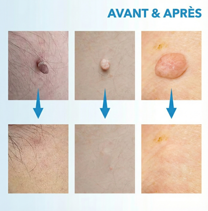 Caleo DermBuddy – Kit Éliminateur d’Étiquettes de Peau